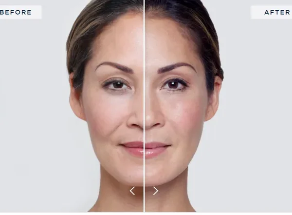 Where to Get Skin Tightening: