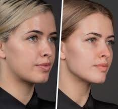 Where to Buy Facial Contouring Injections & Fillers Online